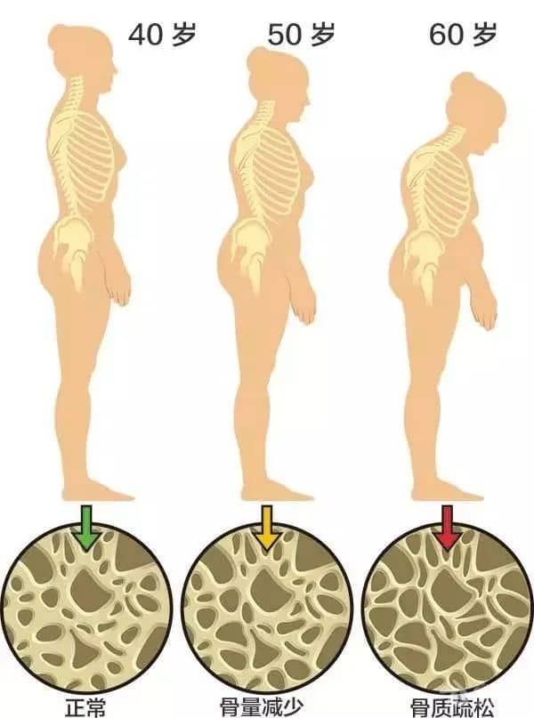 骨質(zhì)疏松是什么_莆田福德醫(yī)院
